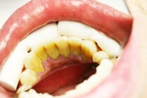Zahnstein und Verfärbungen